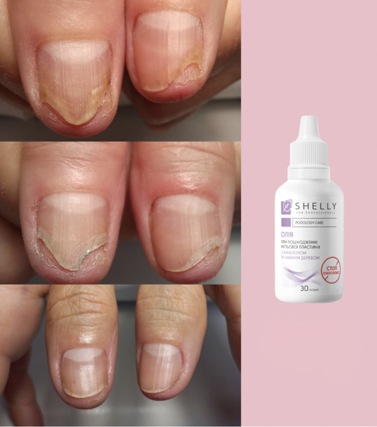 OIL FOR DAMAGE TO THE NAIL PLATE STOP ONYCHOLYSIS SHELLY 30 ML